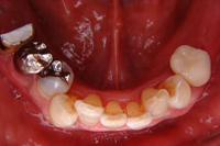 一口腔単位治療 症例3 治療前