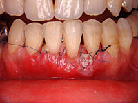 歯周外科症例1