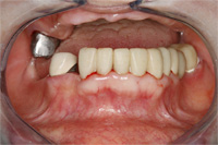 一口腔単位治療 症例4 治療中