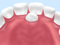 過剰歯の抜歯