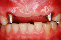 インプラント症例1 治療前