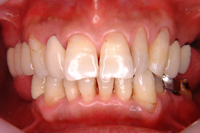 一口腔単位治療 症例3 治療前