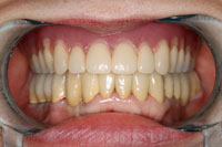 一口腔単位治療 症例4 治療後