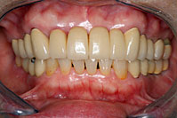 一口腔単位治療 症例5 治療後