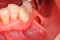 一口腔単位治療 症例6 治療前