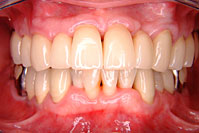 一口腔単位治療 症例6 治療後