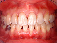 歯周外科症例1 治療前