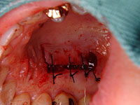 歯周外科症例1 治療直後