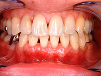 歯周外科症例1 治療後