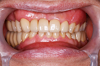 一口腔単位治療 症例1(治療後)