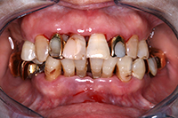 一口腔単位治療 症例1(治療前)