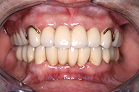 一口腔単位治療 症例1(治療後)