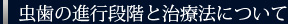 虫歯の進行段階と治療法について