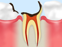 重度の虫歯になった歯