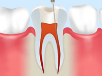 根管治療の様子